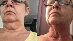 Skin-tightening operation leaves woman with ‘lizard neck’