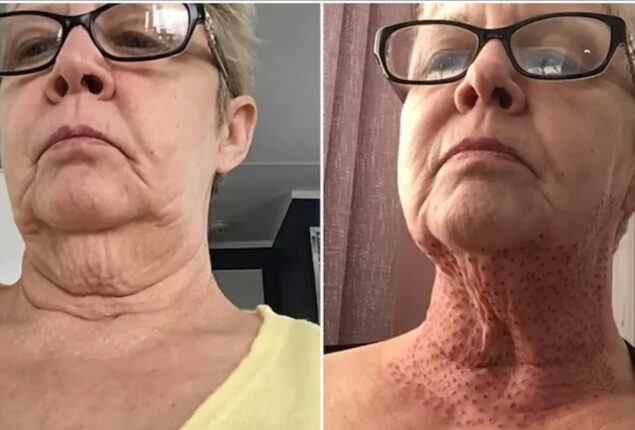 Skin-tightening operation leaves woman with ‘lizard neck’