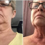 Skin-tightening operation leaves woman with ‘lizard neck’