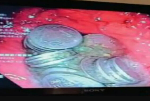 Doctors remove 63 Rs 1 coins from a 36-year-old Jodhpur man