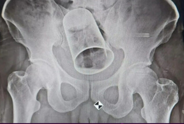 Steel glass surgically removed from a man’s rectum after 10 days
