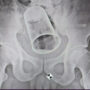 Steel glass surgically removed from a man’s rectum after 10 days