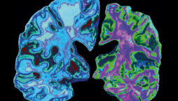 Alzheimer's drug