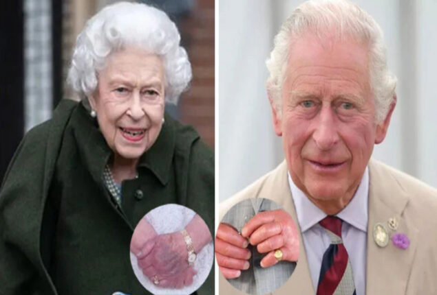 After the death of the Queen, King Charles’ swollen fingers raise health worries