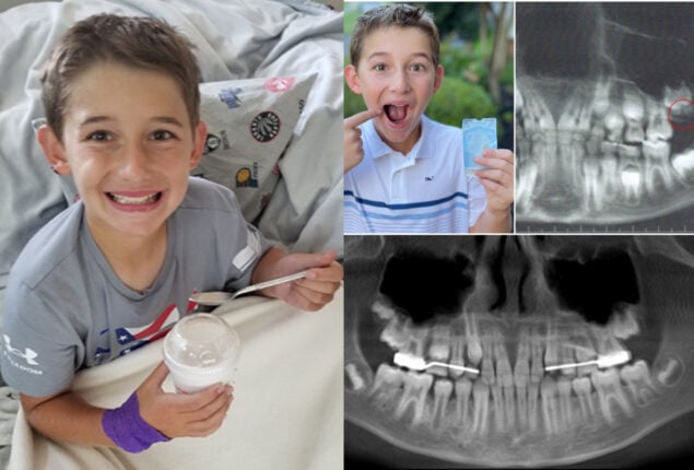 youngest wisdom tooth removed