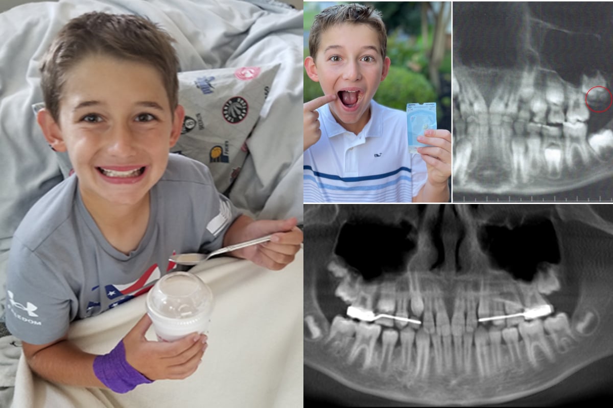 youngest wisdom tooth removed