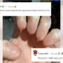 Netizens took a laugh at a Reddit user with Anonychia congenita