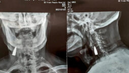 X-ray Reveals WWII Vet’s Bullet Stuck in Neck for 8 Decades