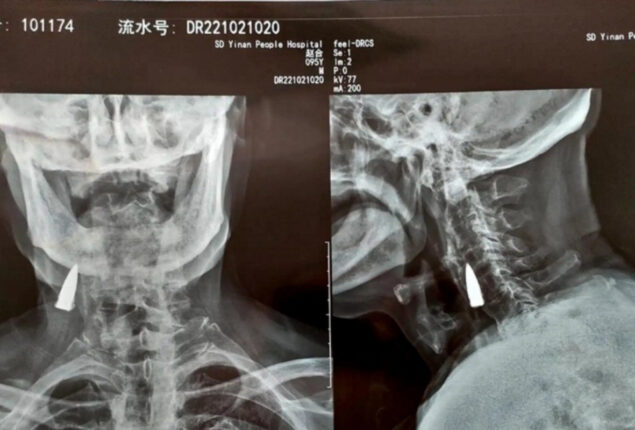 X-ray Reveals WWII Vet’s Bullet Stuck in Neck for 8 Decades