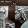 X-ray Reveals WWII Vet’s Bullet Stuck in Neck for 8 Decades