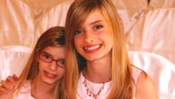 Guinness World Record-winning twins with uncommon condition