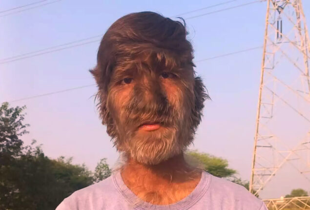Read viral: Boy with ‘werewolf syndrome’ has body hair everywhere