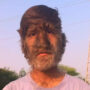 Read viral: Boy with ‘werewolf syndrome’ has body hair everywhere