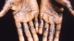 Canada reports first case of clade I mpox