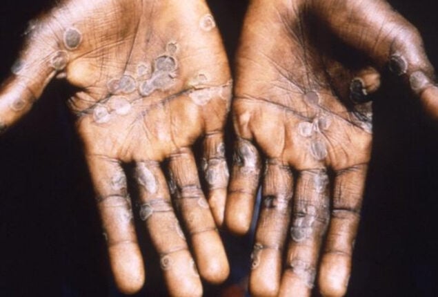 Canada reports first case of clade I mpox