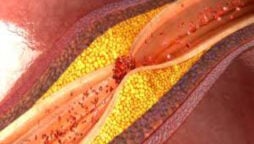 “Good” cholesterol may not prevent heart disease, research