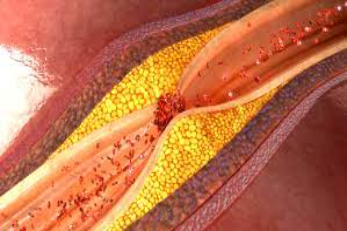 cholesterol