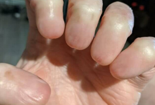 Netizens stunned: hand without fingernails goes viral