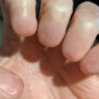 Netizens stunned: hand without fingernails goes viral