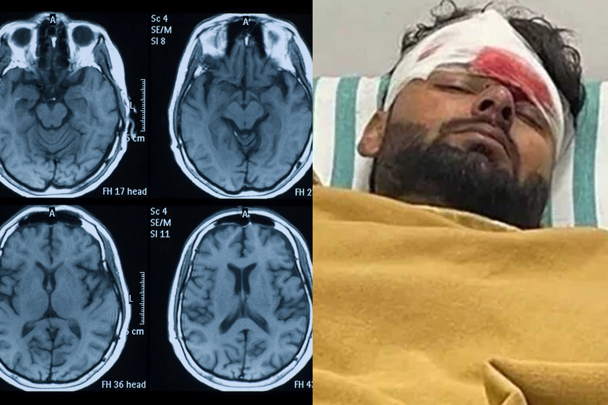 Rishabh Pant's brain and spine MRI results are normal