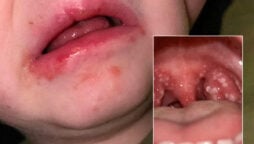 Strep A kills at least 15 children in United Kingdom