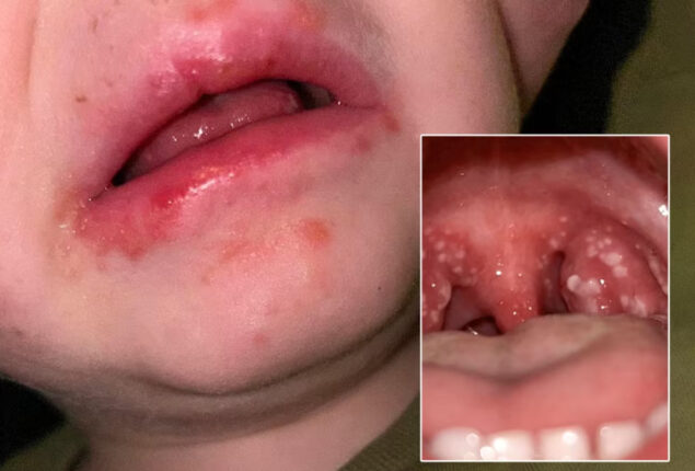 Strep A kills at least 15 children in United Kingdom