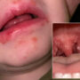 Strep A kills at least 15 children in United Kingdom