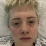 Pneumonia patient waits 31 hours on A&E trolley in Bristol