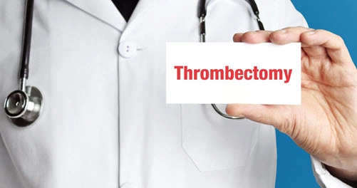 Health expert on Mechanical Thrombectomy