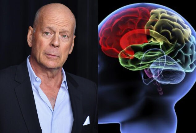 What exactly is Bruce Willis’ condition, frontotemporal dementia?