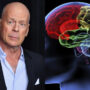 What exactly is Bruce Willis’ condition, frontotemporal dementia?