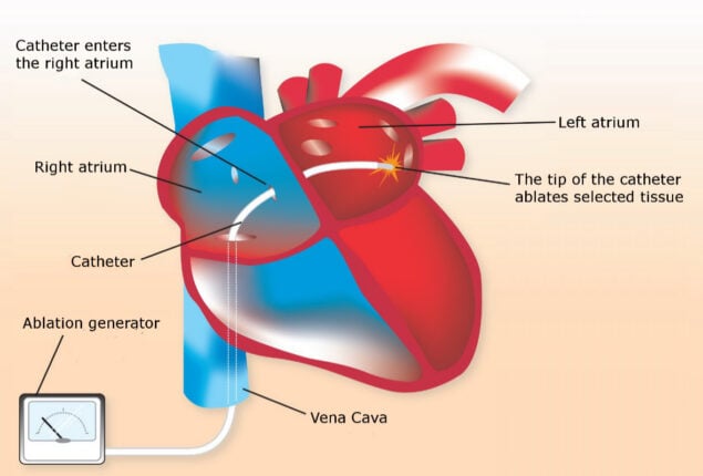 cardiac ablation