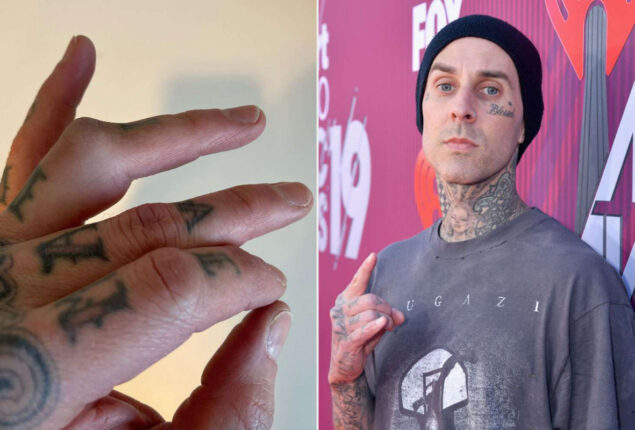 Travis Barker is undergoing surgery to fix a broken finger