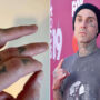 Travis Barker is undergoing surgery to fix a broken finger