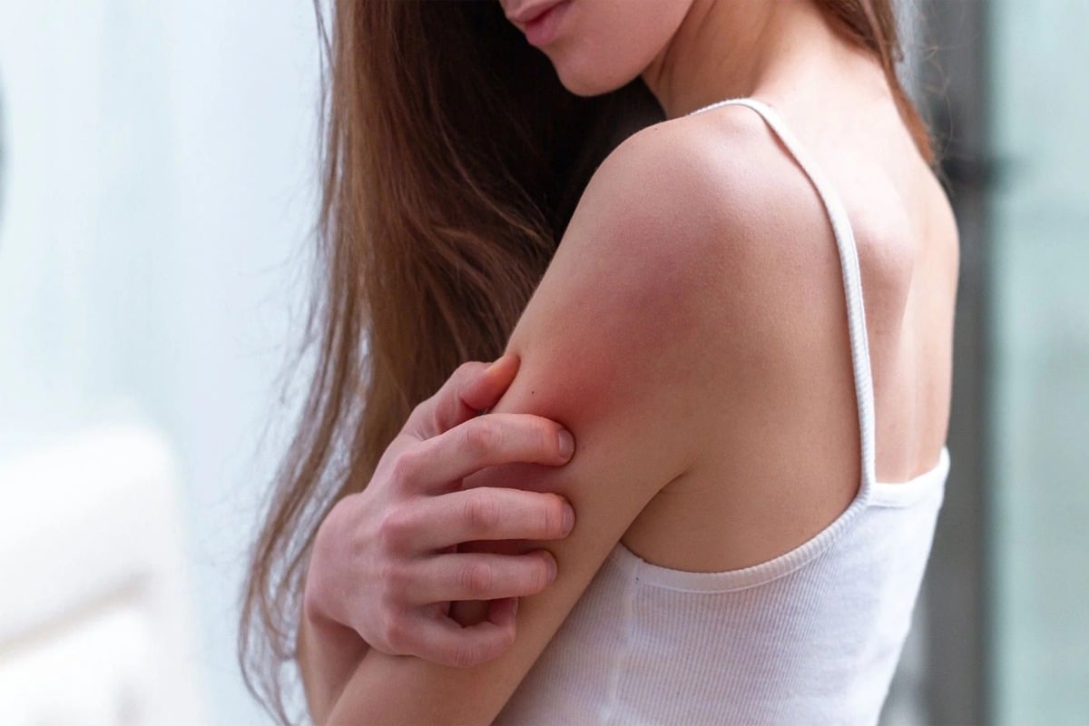 heat rashes