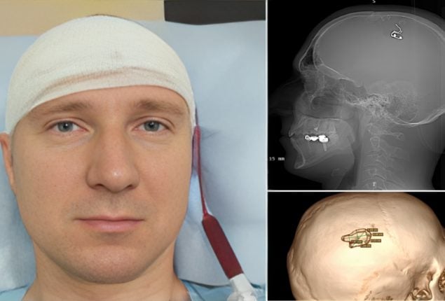 Scientist Performs Self-Brain Surgery to Unlock Dream Control