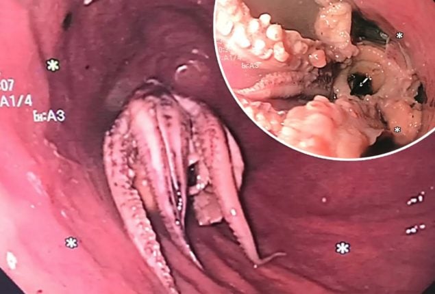 Octopus in Esophagus