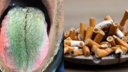 Medication Mix-Up Causes Hairy Green Tongue