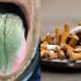 Medication Mix-Up Causes Hairy Green Tongue