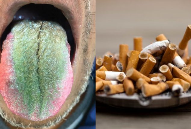 Medication Mix-Up Causes Hairy Green Tongue