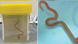 8 cm python roundworm extracted from woman’s brain