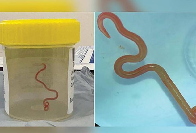 8 cm python roundworm extracted from woman’s brain