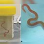8 cm python roundworm extracted from woman’s brain
