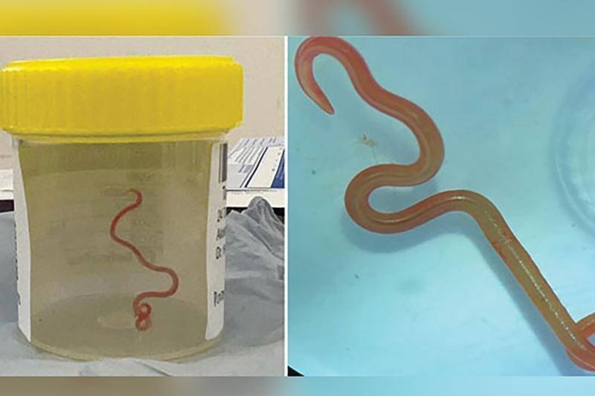 8 cm python roundworm woman's brain