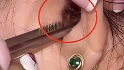 Shocking Moment: Live Cockroach Extracted from Woman’s Ear