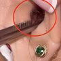 Shocking Moment: Live Cockroach Extracted from Woman’s Ear