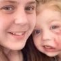 XL Bully Dog Attack Leaves Girl with Lifetime Scar