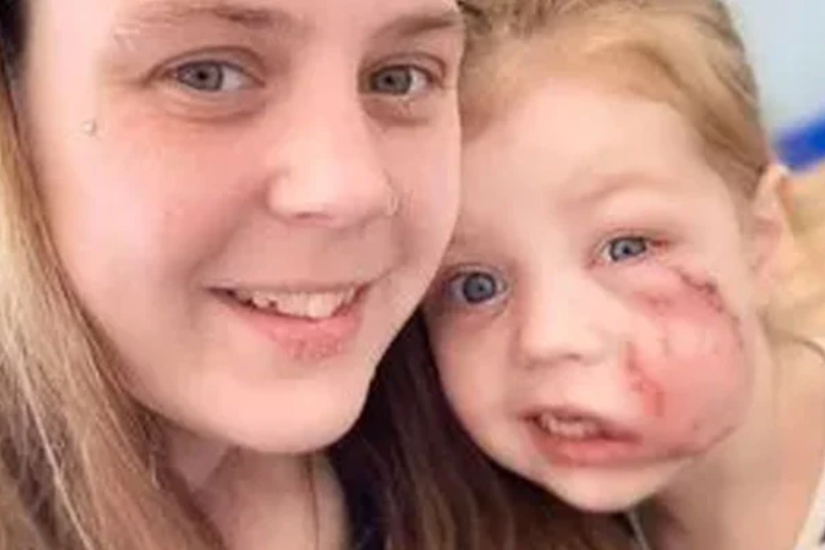 XL Bully Dog Attack Leaves Girl with Lifetime Scar