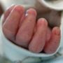 Baby Girl Born with 26 Fingers in India