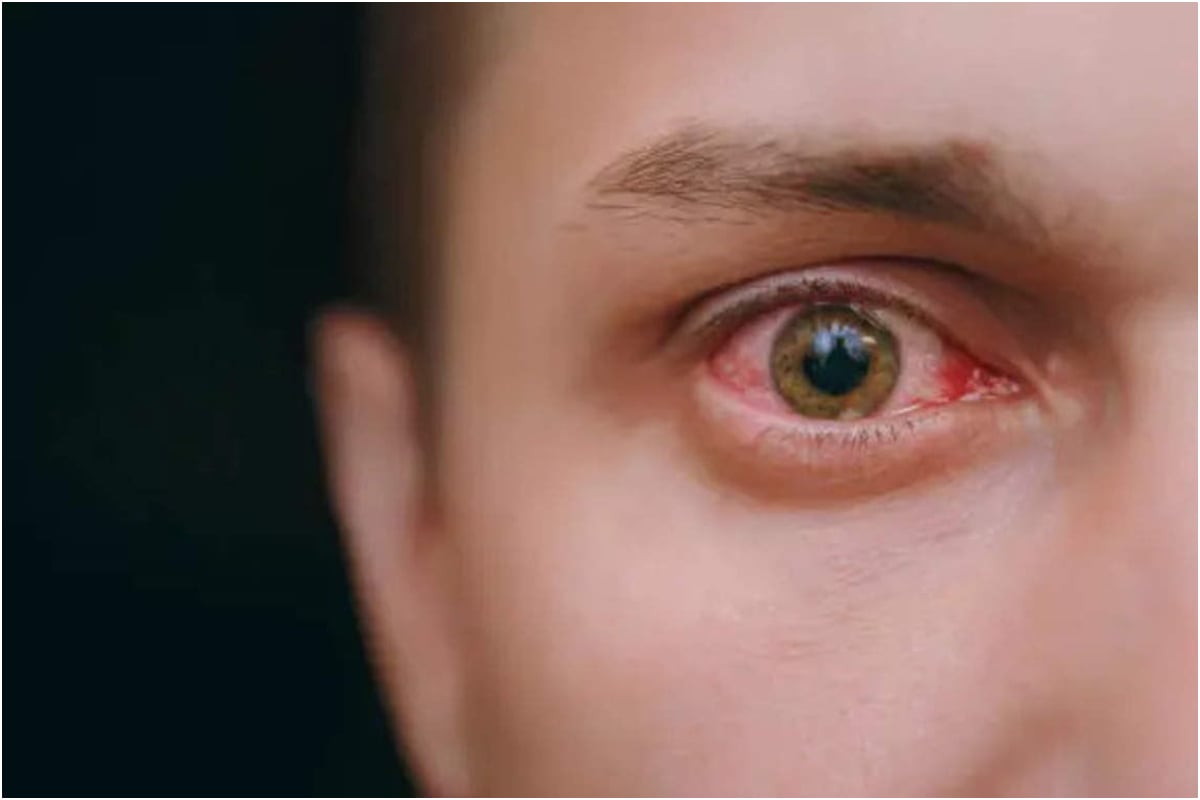pink eye infection